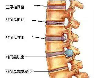 腰間盤突出