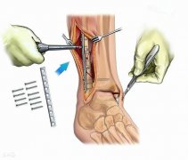 骨折后打的鋼板、鋼釘，一定要取出來嗎？